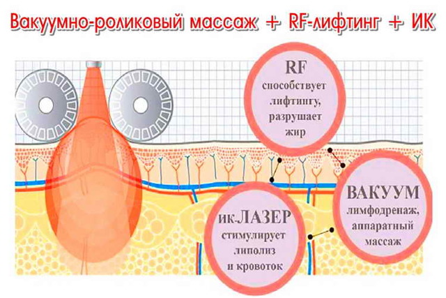 Вакуумний масаж: користь і шкода, як робити, фото до і після, відгуки