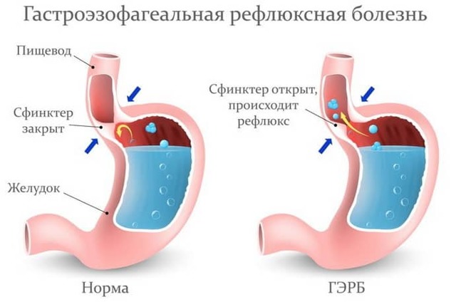 Рефлюкс-гастрит: симптоми і лікування, дієта, меню при гастрорефлюксной хвороби