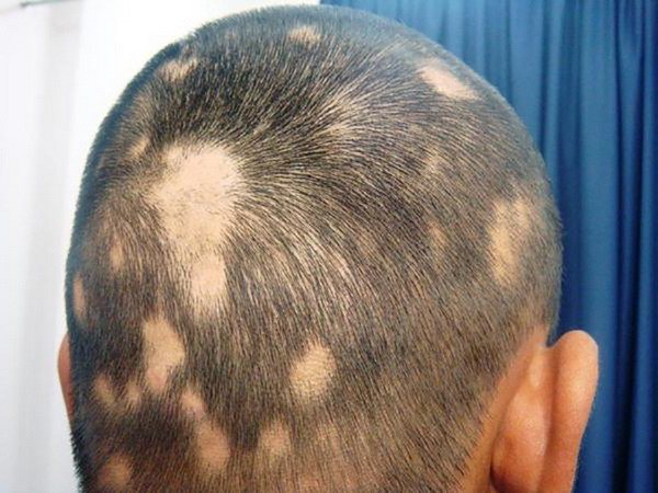 Алопеція у дітей причини і лікування