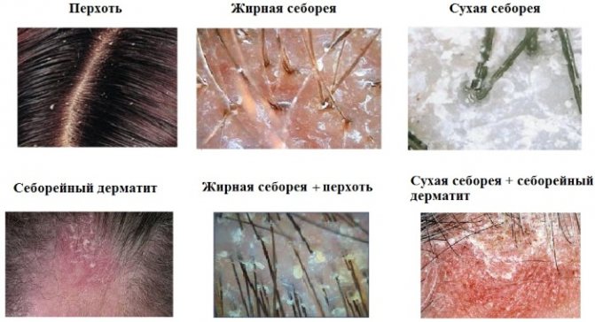 Болячки на голові в волоссі. Фото, причини і лікування в домашніх умовах